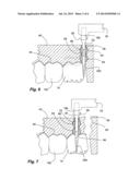 Sleeve for Cutting Bur for Dental Cutting Guide diagram and image