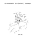 SIDE LOOKING MINIMALLY INVASIVE SURGERY INSTRUMENT ASSEMBLY diagram and image