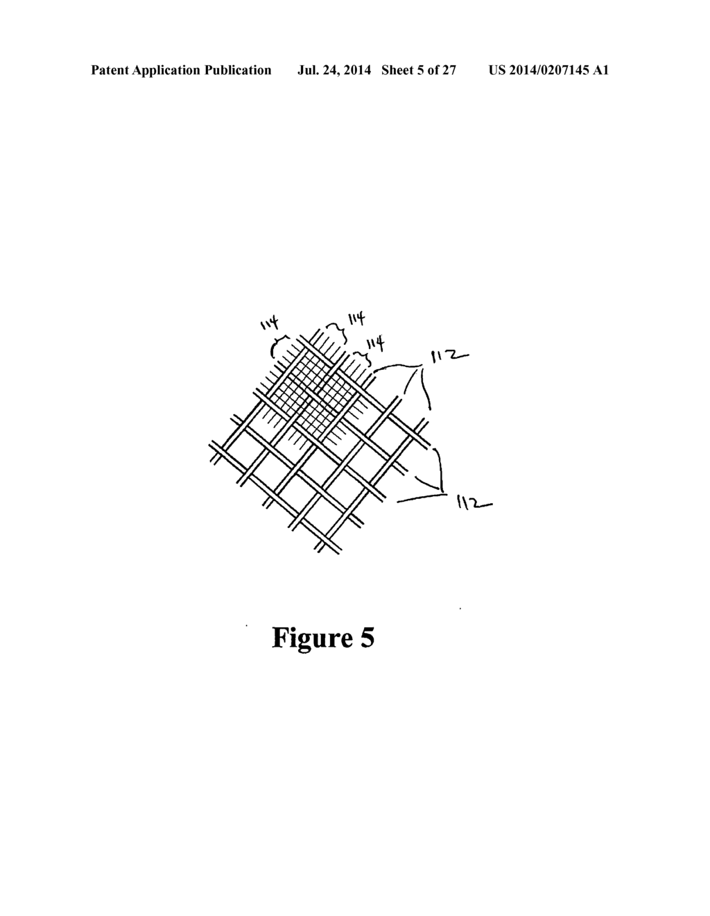 Cement-Directing Orthopedic Implants - diagram, schematic, and image 06