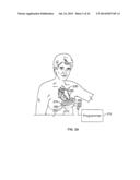 LEADLESS CARDIAC STIMULATION SYSTEMS diagram and image