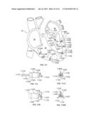 LEADLESS CARDIAC STIMULATION SYSTEMS diagram and image