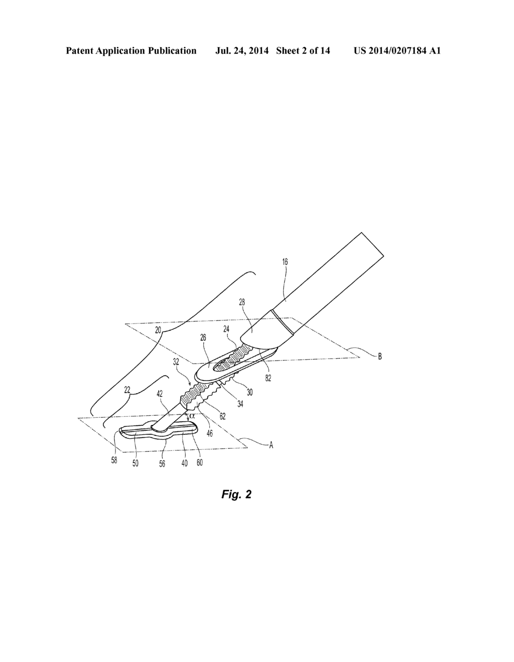 Vessel Sealing Device - diagram, schematic, and image 03