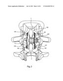 Spinous Process Fusion Implants and Insertion, Compression, and Locking     Instrumentation diagram and image