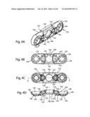 Spinous Process Fusion Implants and Insertion, Compression, and Locking     Instrumentation diagram and image