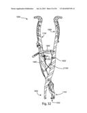 Spinous Process Fusion Implants and Insertion, Compression, and Locking     Instrumentation diagram and image