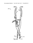 Spinous Process Fusion Implants and Insertion, Compression, and Locking     Instrumentation diagram and image