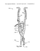 Spinous Process Fusion Implants and Insertion, Compression, and Locking     Instrumentation diagram and image