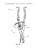 Spinous Process Fusion Implants and Insertion, Compression, and Locking     Instrumentation diagram and image