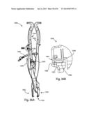 Spinous Process Fusion Implants and Insertion, Compression, and Locking     Instrumentation diagram and image