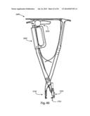 Spinous Process Fusion Implants and Insertion, Compression, and Locking     Instrumentation diagram and image