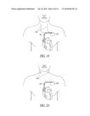 NEURAL STIMULATION SYSTEMS, DEVICES AND METHODS diagram and image