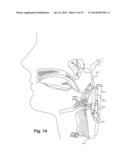 Apparatus and Method to Control an Implant diagram and image