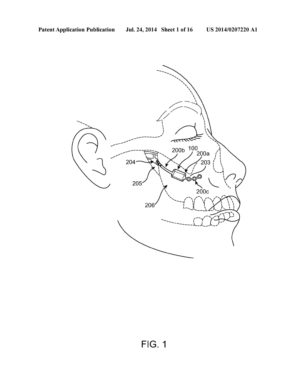 Implantable Neurostimulator with Integral Hermetic Electronic Enclosure,     Circuit Substrate, Monolithic Feed-Through, Lead Assembly and Anchoring     Mechanism - diagram, schematic, and image 02