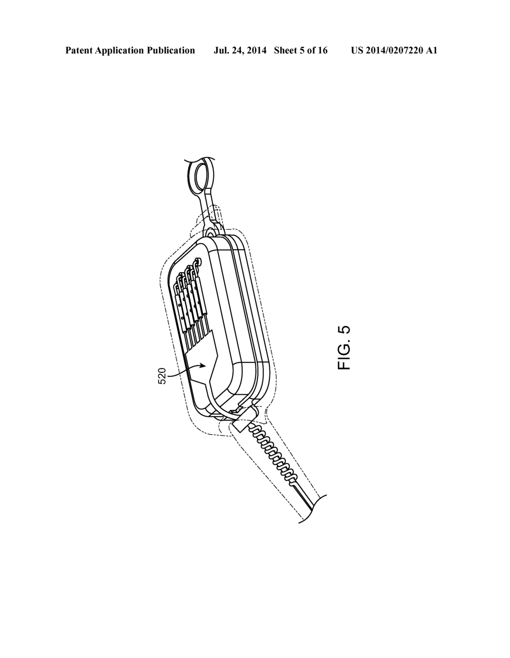 Implantable Neurostimulator with Integral Hermetic Electronic Enclosure,     Circuit Substrate, Monolithic Feed-Through, Lead Assembly and Anchoring     Mechanism - diagram, schematic, and image 06