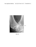 NON-PLANAR ORTHOPEDIC IMPLANTS AND METHODS diagram and image