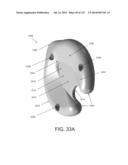 NON-PLANAR ORTHOPEDIC IMPLANTS AND METHODS diagram and image