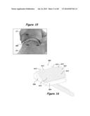 Joint Arthroplasty Systems, Methods, and Components diagram and image