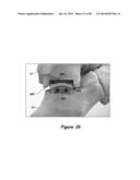 Joint Arthroplasty Systems, Methods, and Components diagram and image