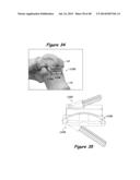 Joint Arthroplasty Systems, Methods, and Components diagram and image