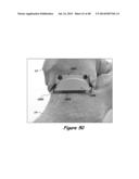 Joint Arthroplasty Systems, Methods, and Components diagram and image