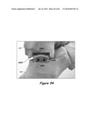 Joint Arthroplasty Systems, Methods, and Components diagram and image