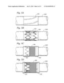 METHODS OF MAKING ENCAPSULATED HEART VALVES diagram and image