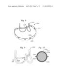 METHODS OF MAKING ENCAPSULATED HEART VALVES diagram and image