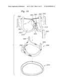 METHODS OF MAKING ENCAPSULATED HEART VALVES diagram and image