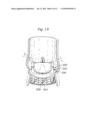 METHODS OF MAKING ENCAPSULATED HEART VALVES diagram and image