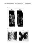 SCREENING METHOD FOR THERAPEUTIC AGENT FOR CHONDROPATHY AND MODIFIED     CHONDROCYTE FOR TREATMENT OF CHONDROPATHY diagram and image