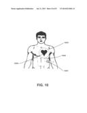 APPARATUS AND METHOD FOR ELECTROMAGNETIC TREATMENT OF NEUROLOGICAL PAIN diagram and image