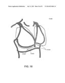 APPARATUS AND METHOD FOR ELECTROMAGNETIC TREATMENT OF NEUROLOGICAL PAIN diagram and image