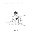 APPARATUS AND METHOD FOR ELECTROMAGNETIC TREATMENT OF NEUROLOGICAL PAIN diagram and image