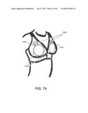 APPARATUS AND METHOD FOR ELECTROMAGNETIC TREATMENT OF NEUROLOGICAL PAIN diagram and image