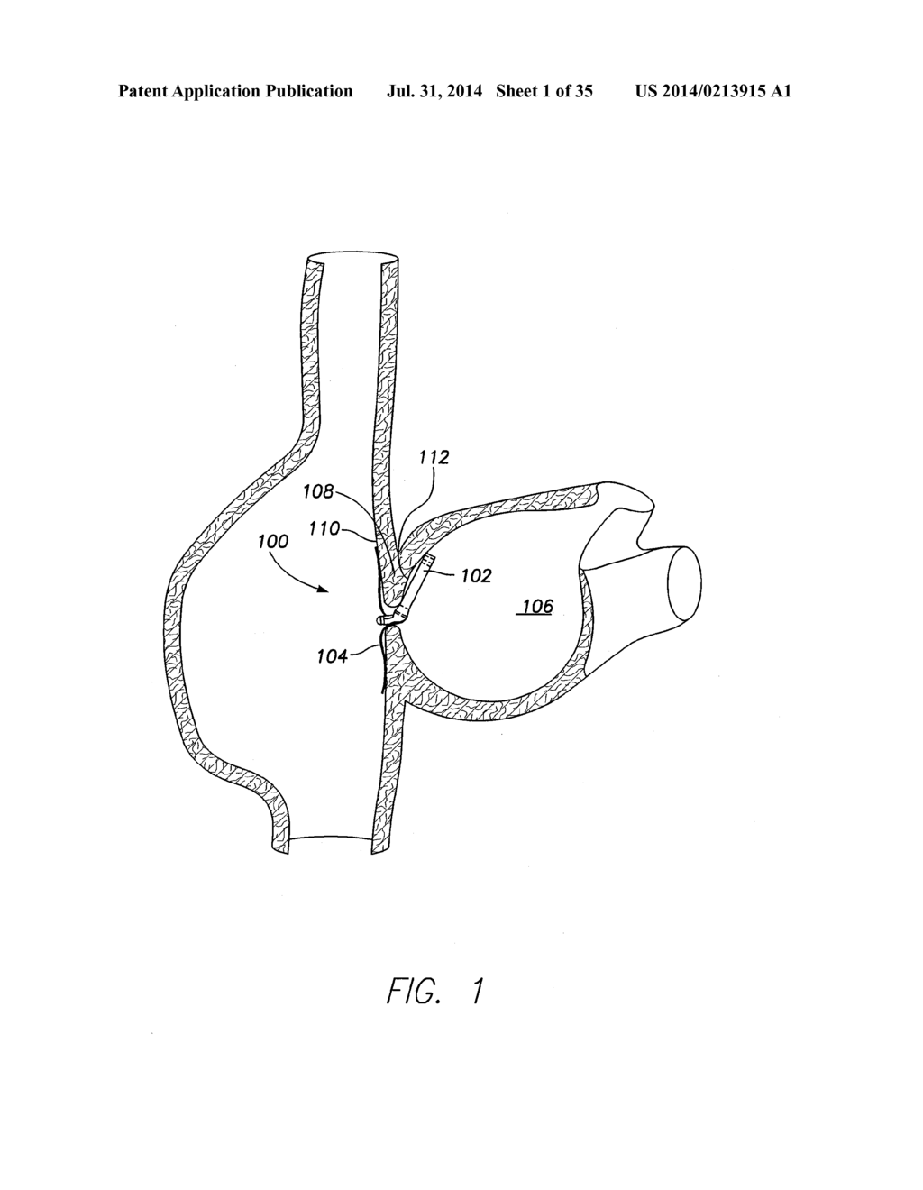 WIRELESS MEMS LEFT ATRIAL PRESSURE SENSOR - diagram, schematic, and image 02