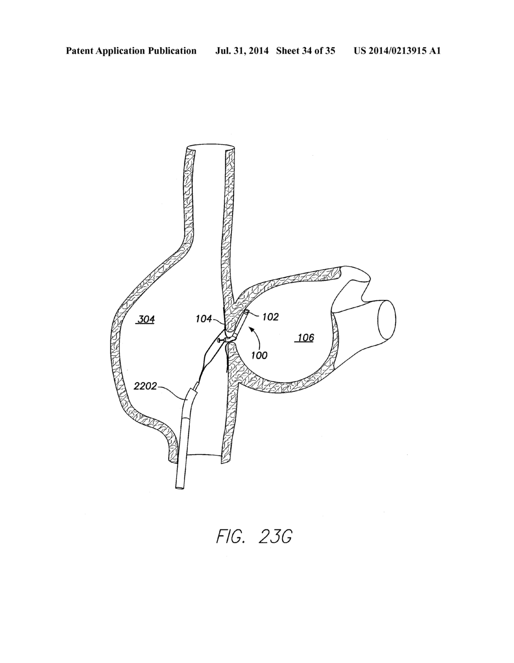 WIRELESS MEMS LEFT ATRIAL PRESSURE SENSOR - diagram, schematic, and image 35