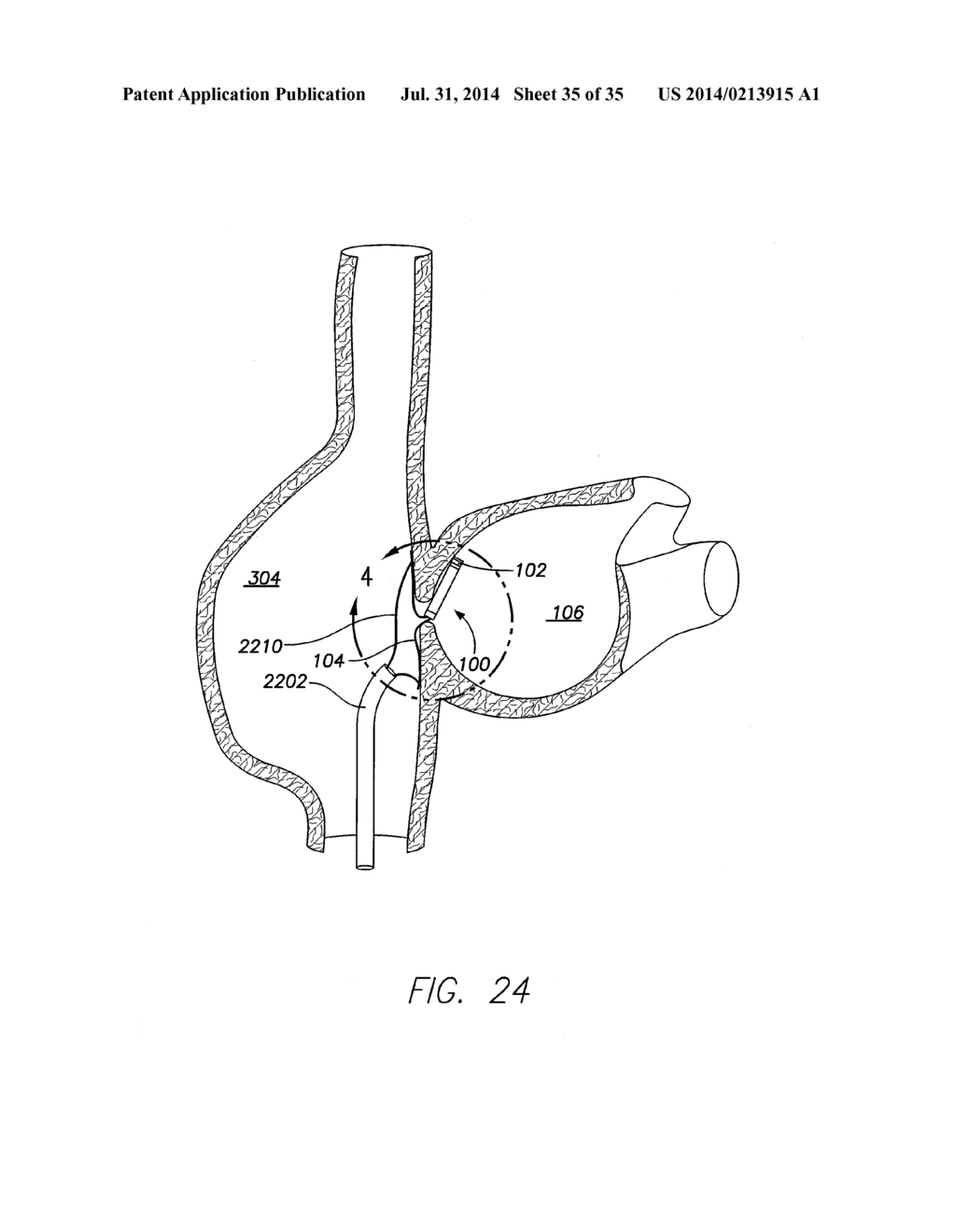 WIRELESS MEMS LEFT ATRIAL PRESSURE SENSOR - diagram, schematic, and image 36