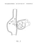 WIRELESS MEMS LEFT ATRIAL PRESSURE SENSOR diagram and image