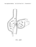 WIRELESS MEMS LEFT ATRIAL PRESSURE SENSOR diagram and image