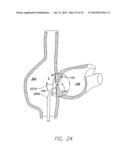 WIRELESS MEMS LEFT ATRIAL PRESSURE SENSOR diagram and image