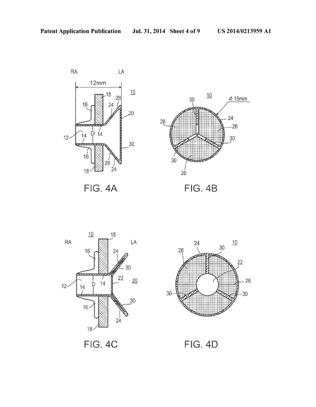 DEVICE AND METHOD FOR REGULATING PRESSURE IN A HEART CHAMBER - diagram, schematic, and image 05