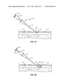 SYSTEMS AND METHODS FOR VENIPUNCTURE AND CATHETER PLACEMENT diagram and image