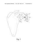 ORTHOPAEDIC SURGICAL SAW ASSEMBLY FOR REMOVING AN IMPLANTED GLENOID     COMPONENT AND METHOD OF USING THE SAME diagram and image