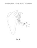 ORTHOPAEDIC SURGICAL SAW ASSEMBLY FOR REMOVING AN IMPLANTED GLENOID     COMPONENT AND METHOD OF USING THE SAME diagram and image