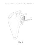 ORTHOPAEDIC SURGICAL SAW ASSEMBLY FOR REMOVING AN IMPLANTED GLENOID     COMPONENT AND METHOD OF USING THE SAME diagram and image