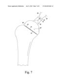 ORTHOPAEDIC SURGICAL SAW ASSEMBLY FOR REMOVING AN IMPLANTED GLENOID     COMPONENT AND METHOD OF USING THE SAME diagram and image