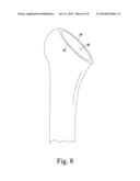 ORTHOPAEDIC SURGICAL SAW ASSEMBLY FOR REMOVING AN IMPLANTED GLENOID     COMPONENT AND METHOD OF USING THE SAME diagram and image