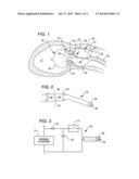 SHOCK WAVE VALVULOPLASTY DEVICE WITH MOVEABLE SHOCK WAVE GENERATOR diagram and image