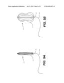 AORTIC GREAT VESSEL PROTECTION diagram and image