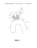 AORTIC GREAT VESSEL PROTECTION diagram and image